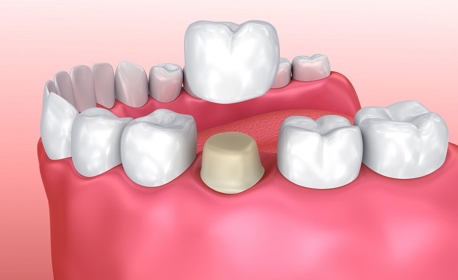 Why is it Important to Crown Your Tooth after a Root Canal